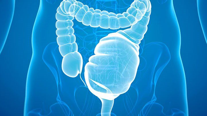 toxic megacolon